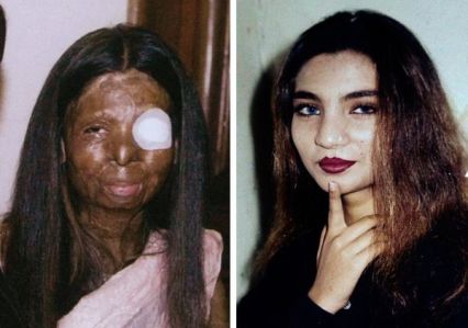 A woman before and after an acid attack: She is free to choose her doctor, but not husband.